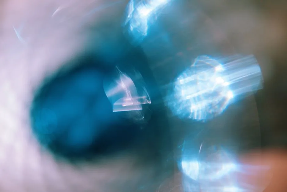 Cataract Fundoscopy Findings: What They Reveal