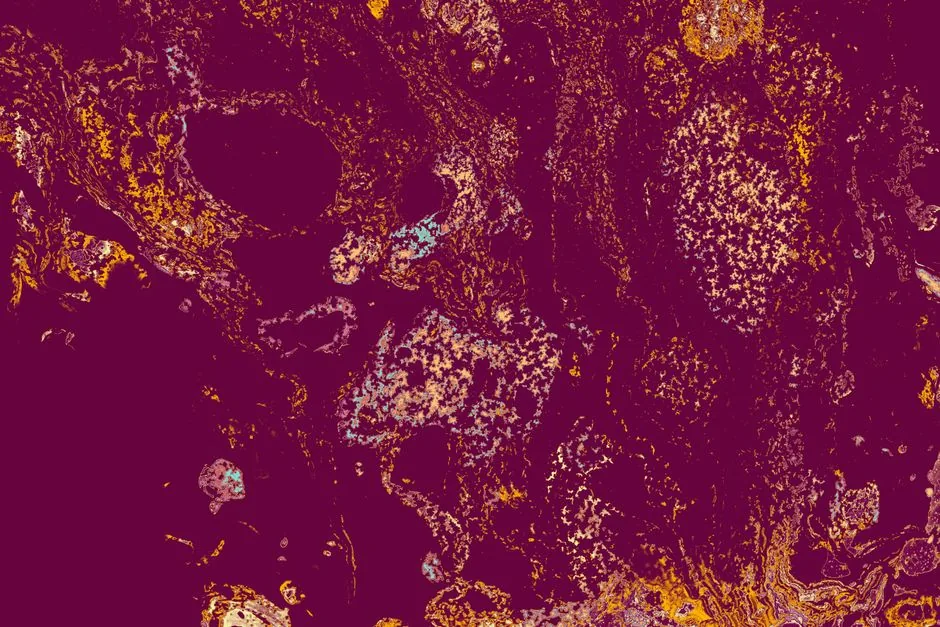 2.5 cm Adrenal Nodule: What You Need to Know