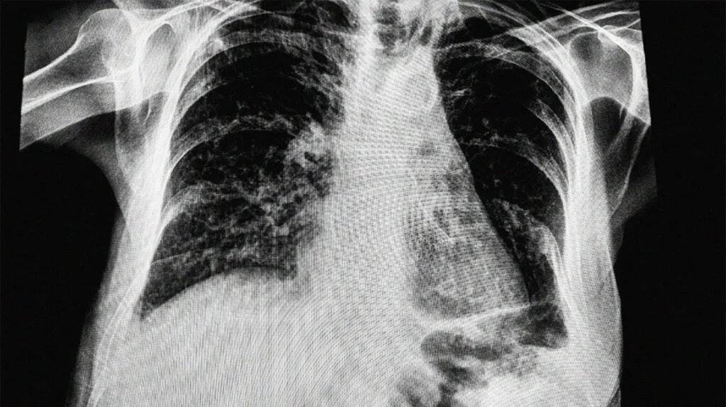 6 Months After Mitral Valve Replacement: What to Expect