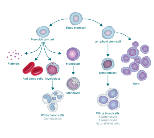 Acute lymphoblastic leukemia stages – what you need to know