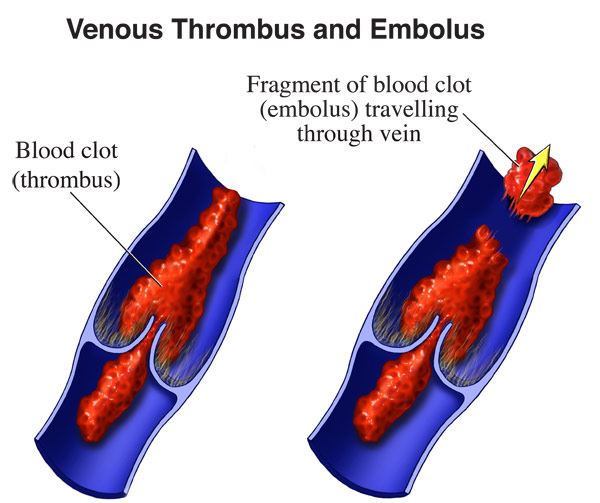 Can a Blood Clot in the Heart Be Dissolved? Now