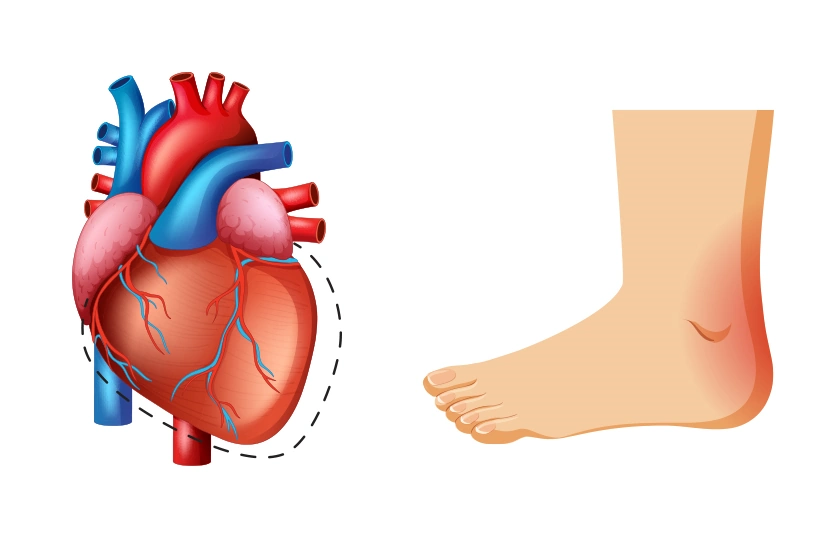 Congestive Heart Failure Swollen Feet Treatment Guide