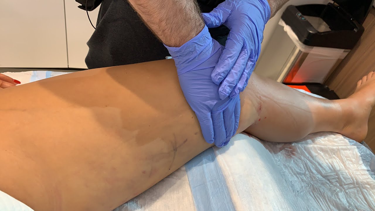 Draining Fluid from Legs in Hospital: Essential Facts You Need