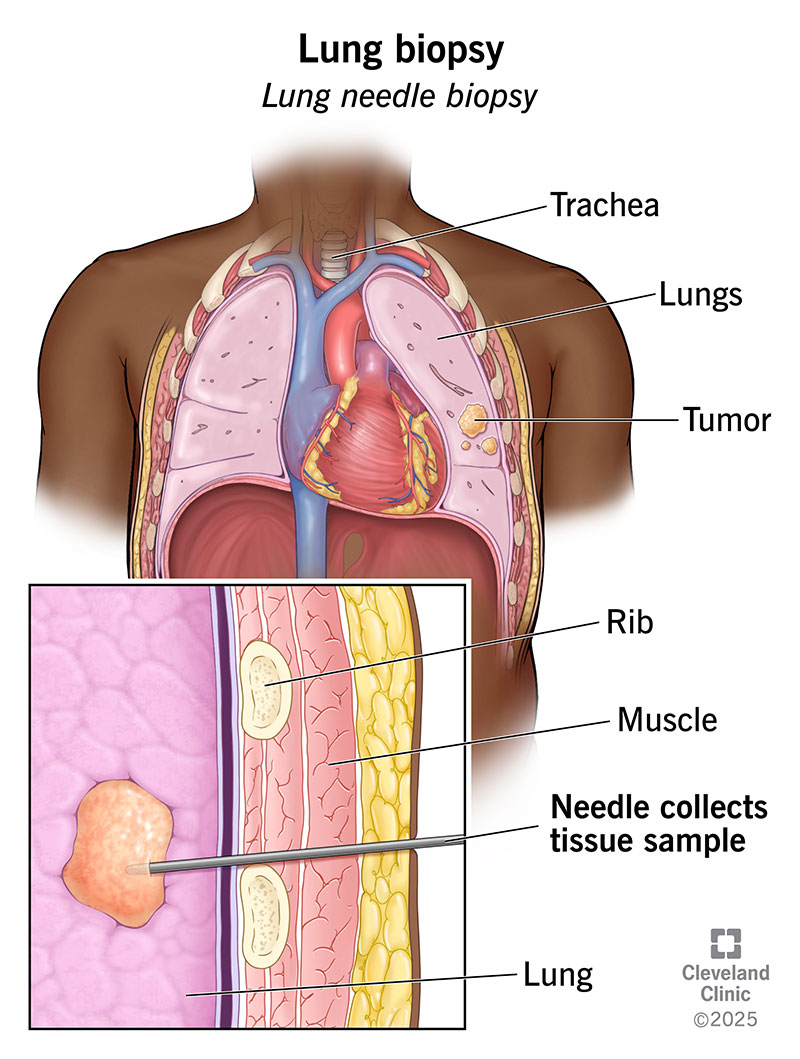 Lung Biopsy Procedure: What to Expect, Risks & Recovery