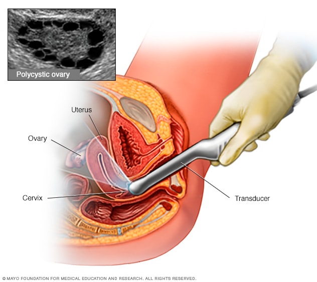 PCOS Testing: How to Diagnose and Manage the Condition