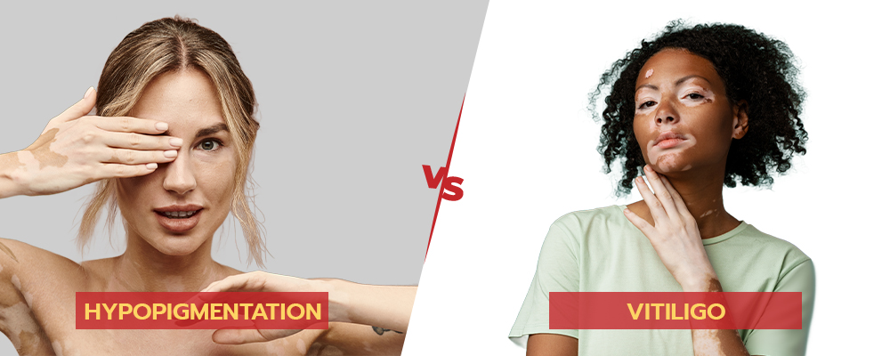 post inflammatory hypopigmentation vs vitiligo