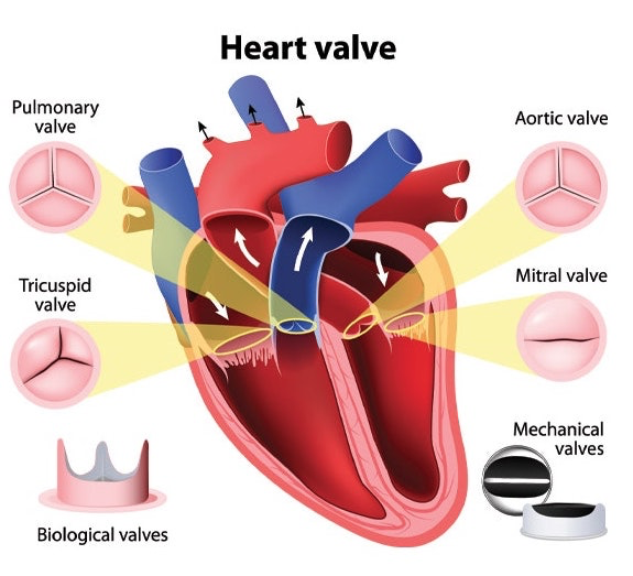 Reasons for Heart Valve Replacement: Essential Guide