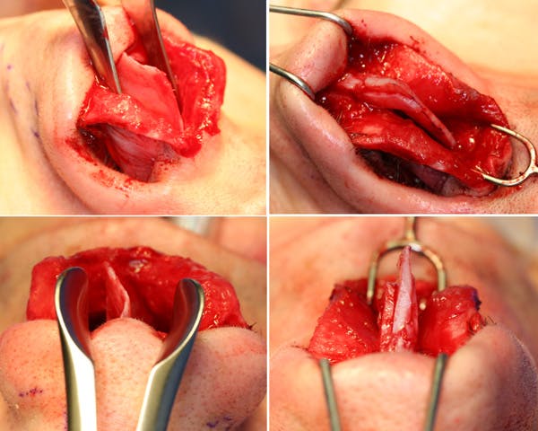 Septoplasty Surgery: What to Expect, Cost and Recovery