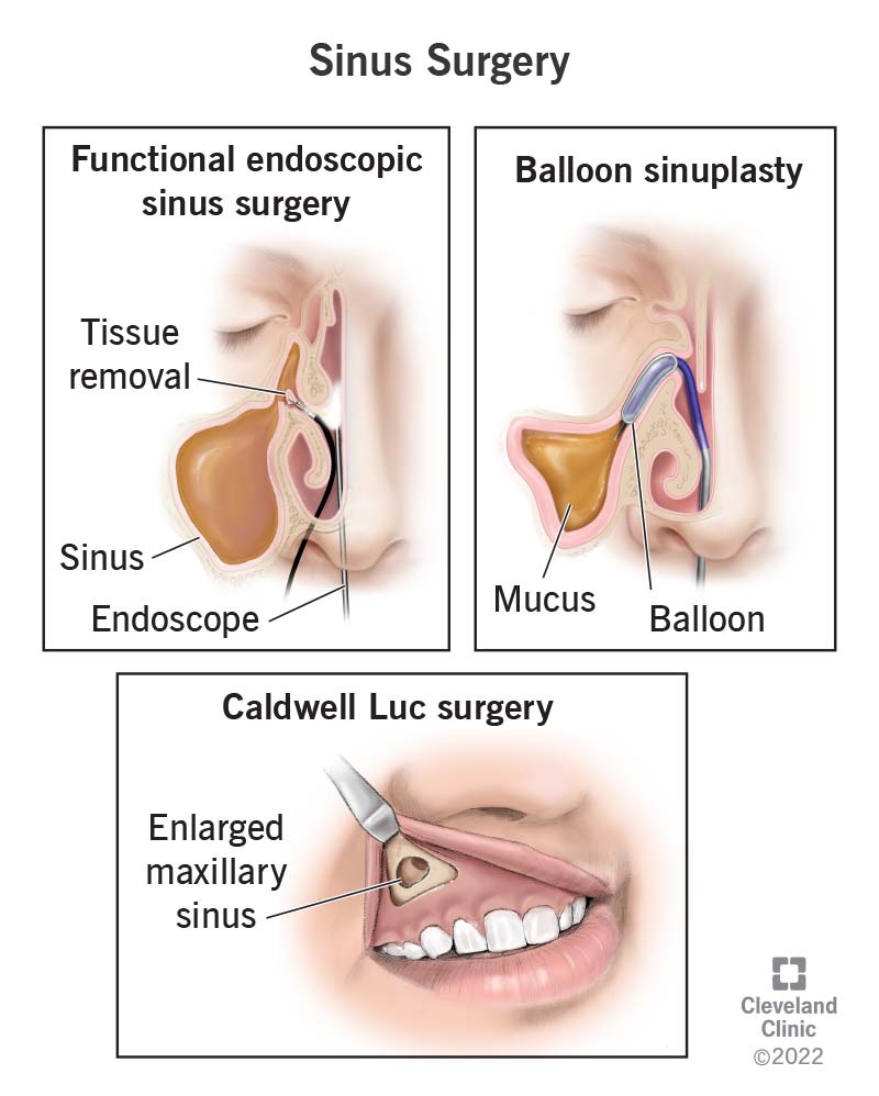 Sinus Surgery Recovery: Your Complete Day‑by‑Day Guide