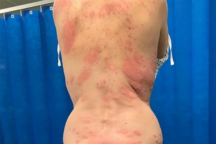 Vaping Allergy Symptoms: Spot Them Fast & Find Relief