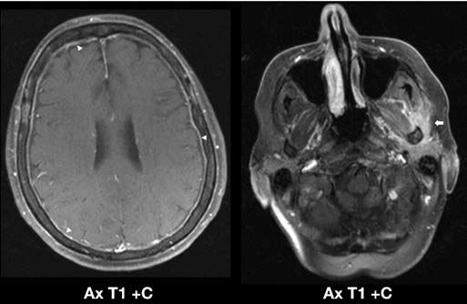 AML Encephalopathy – What It Is, Risks & What to Expect