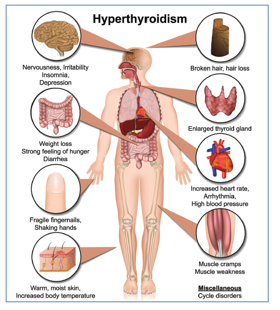 Overactive Thyroid Symptoms in Females – Quick Guide