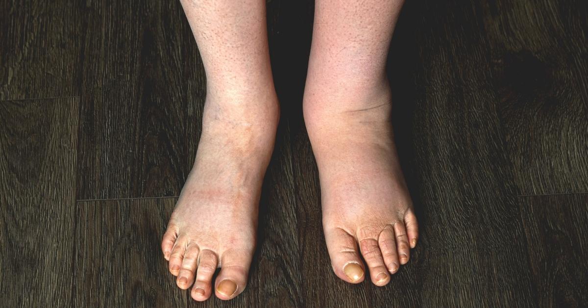 Swelling in One Foot Only: When to Worry and What to Do