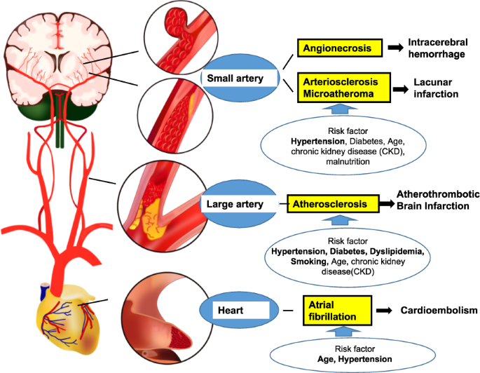 Hypertension and Stroke PubMed: Key Findings You Need