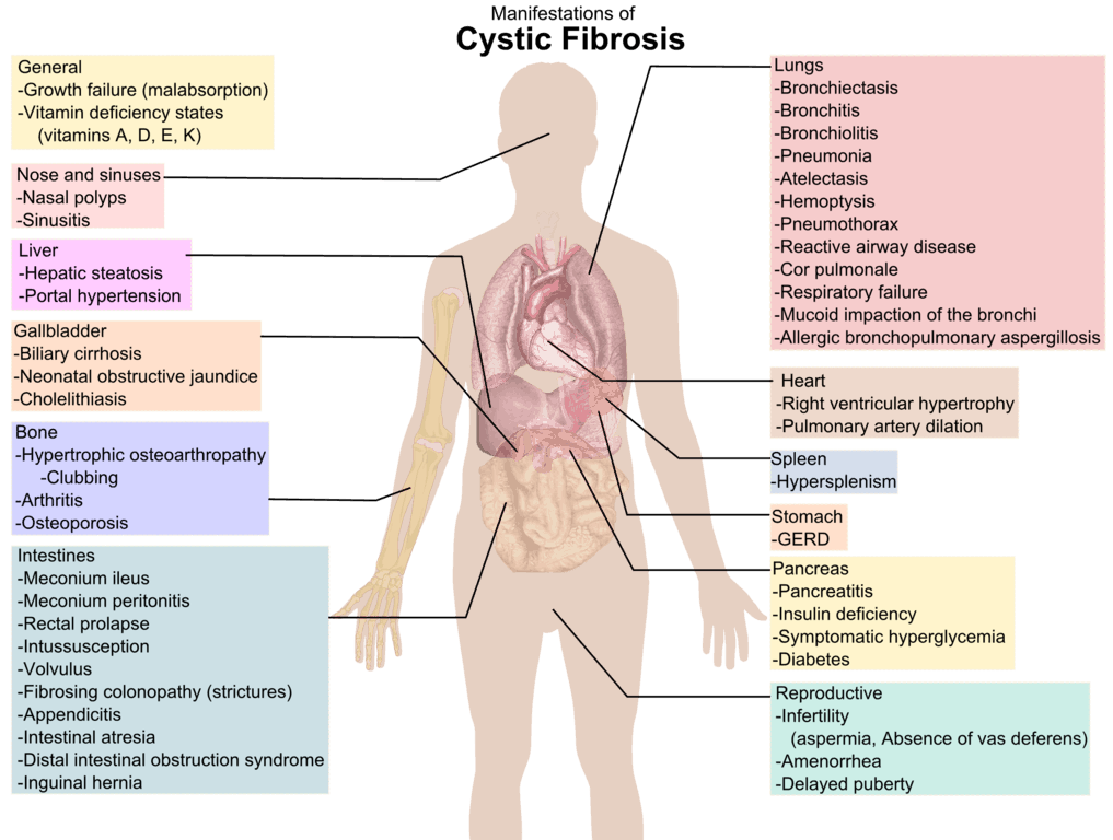Female Cystic Fibrosis Life Expectancy: Key Facts