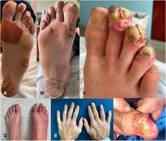 Migratory Arthritis & COVID‑19: What You Need to Know