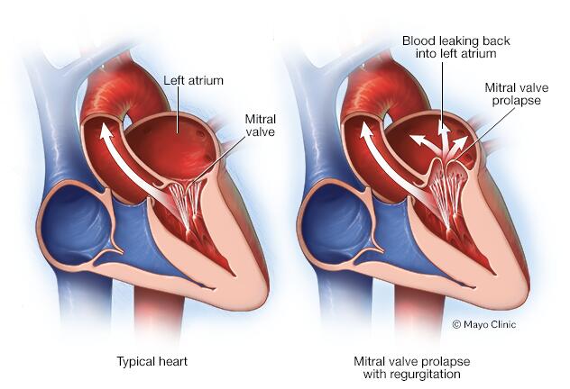 Mitral Valve Prolapse: Symptoms, Causes & Treatment