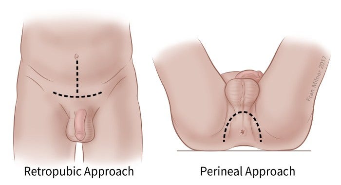 Open Prostatectomy: Definition, Steps, Risks & Recovery