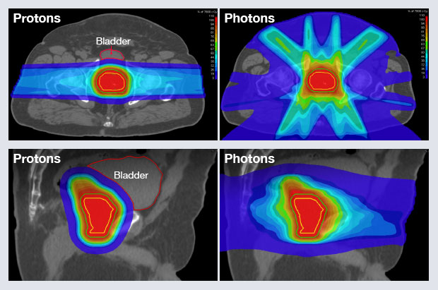 Proton Therapy for Prostate Cancer: How Many Treatments?