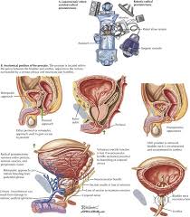 Radical Prostatectomy Steps: A Friendly Complete Guide