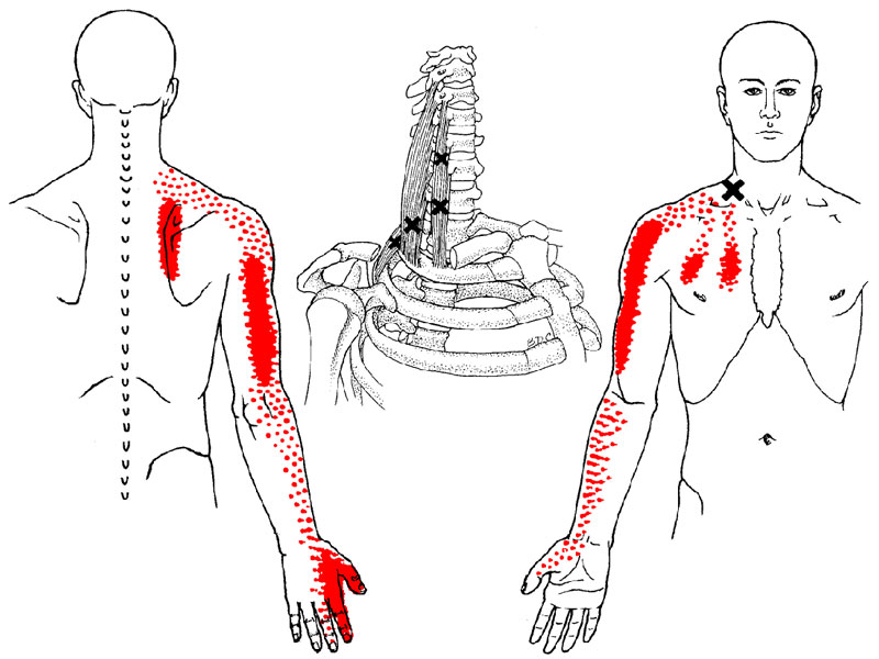 Trigger Points in Body: What They Are & How to Treat