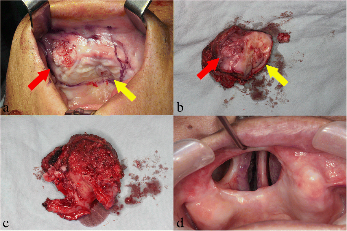 Verrucous Carcinoma Survival Rate: Key Facts