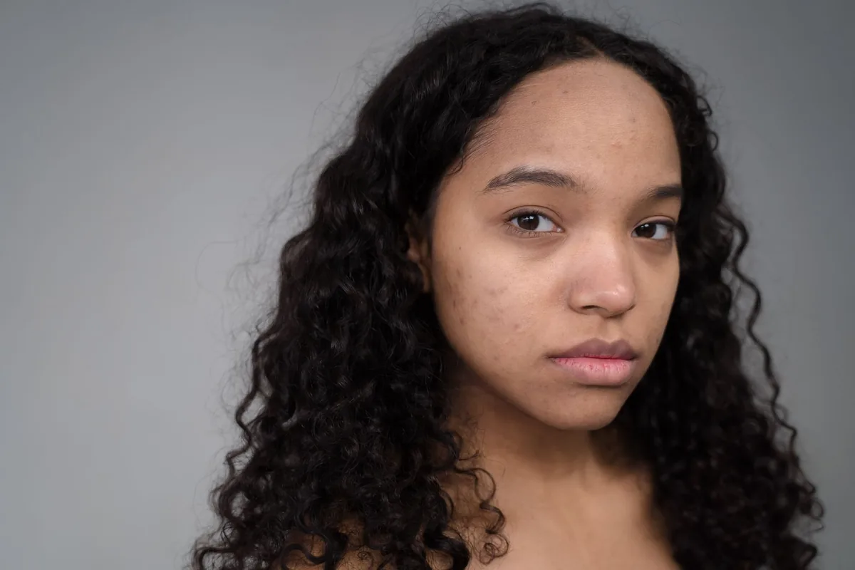 How to Understand the Chocolate Effect on Acne-Prone Skin Without Falling for Myths